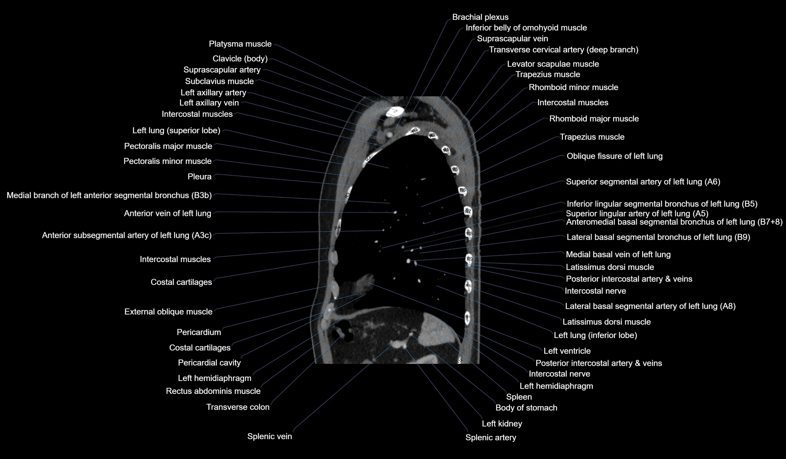 CT chest (thorax) soft tissue window labelled sagittal cross sectional anatomy radiology image-00105.webp
